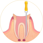 根管治療-トップ2