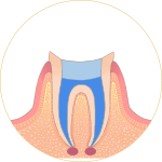 根管治療-トップ3