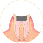 根管治療-トップ4