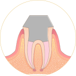 根管治療-トップ5