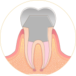 根管治療-トップ6