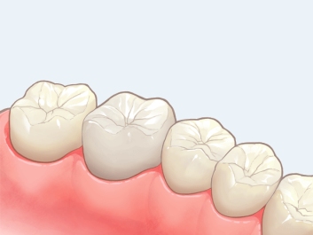 オールセラミックス-インレー