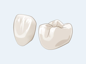 ジルコニア-インレー