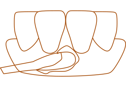 表面麻酔-アイコン