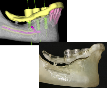 インプラント-CT画像