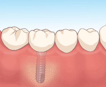 インプラント