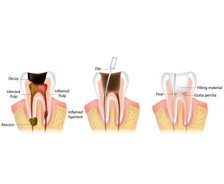 治療-根管治療3