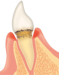 歯周病段階②
