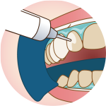 オフィスホワイトニング-4